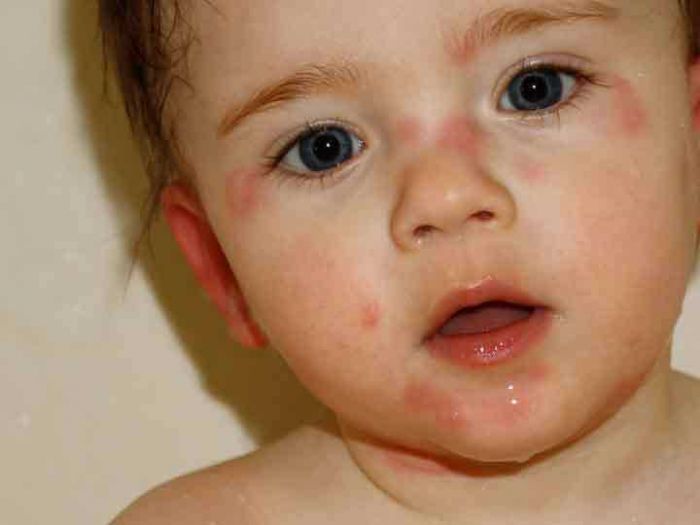 Baby Allergic Reaction To Eggs