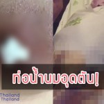 อุทาหรณ์! สำหรับคุณแม่มือใหม่ ปั๊มนมไม่เกลี้ยงเต้าจนต้องผ่าตัด