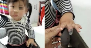อุทาหรณ์! เด็กหญิงชาวจีน ต้องตัดนิ้วทิ้ง เพราะติดพลาสเตอร์แน่นเกินไป