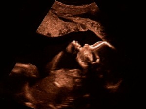 ดูอาการสะอึกของทารกในครรภ์ผ่านคลิปอัลตราซาวด์