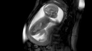 ทำ MRI  ดูการเคลื่อนไหวของทารกในครรภ์ และหาความพิการของทารกในครรภ์ได้อย่างแม่นยำ