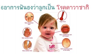 โรคคาวาซากิ โรคอันตรายในเด็กที่แม่ต้องรู้ ที่แม่ต้องเช็ค!!!