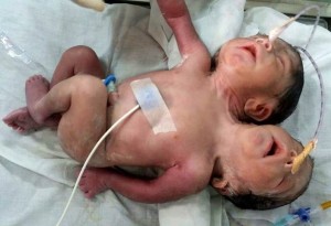 ทารกแฝดติดกันเสียชีวิต เพราะพ่อแม่ปฎิเสธการรักษา
